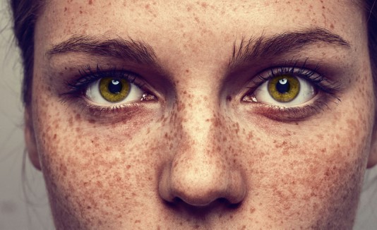 Manchas inusuales en la piel, lunares o pecas, pueden ser signos de melanoma: IMSS