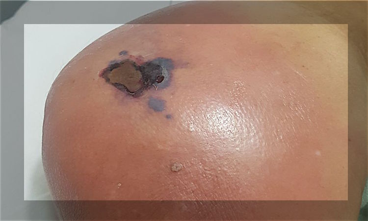 Inyecciones “mágicas” matarían ya a 6 personas en Oaxaca
