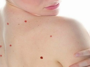 IMSS: Lunares rojos pueden deberse a desórdenes hepáticos